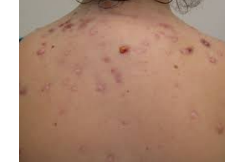 A person's back displays numerous acne lesions of varying sizes and stages of healing.