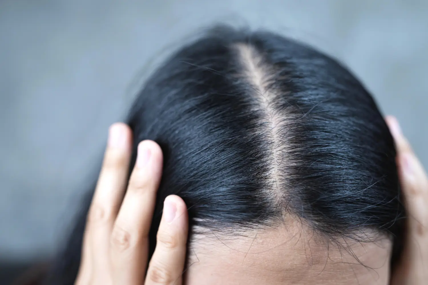 Menopause-Related Hair Thinning